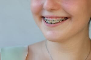 invisalign vs braces
